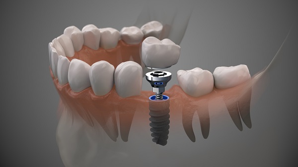 Dental Implant