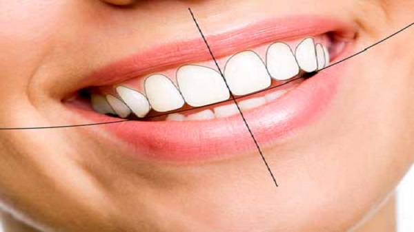 Smile Designing