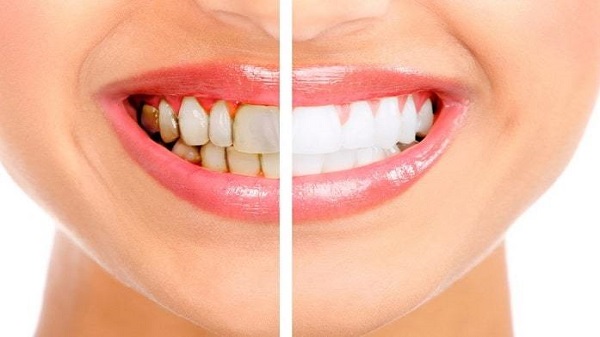 Teeth Whitening & Bleaching